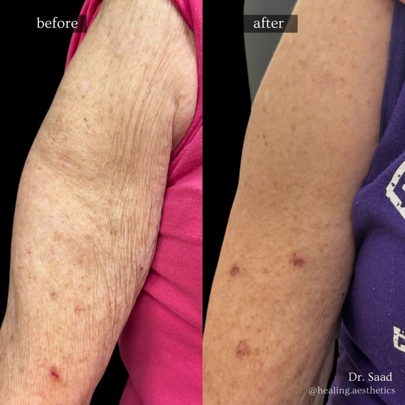 Sculptra before and after - arm skin rejuvenation
