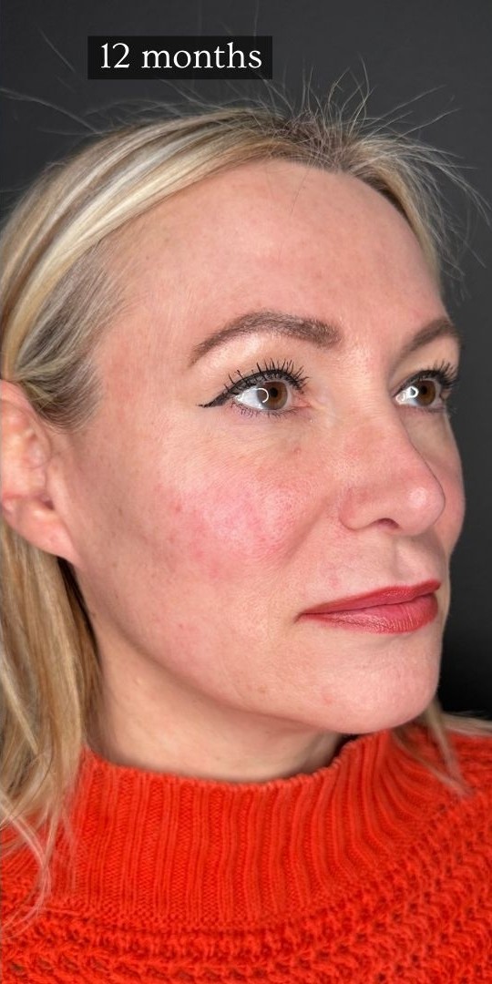 Sculptra face results after 12 months